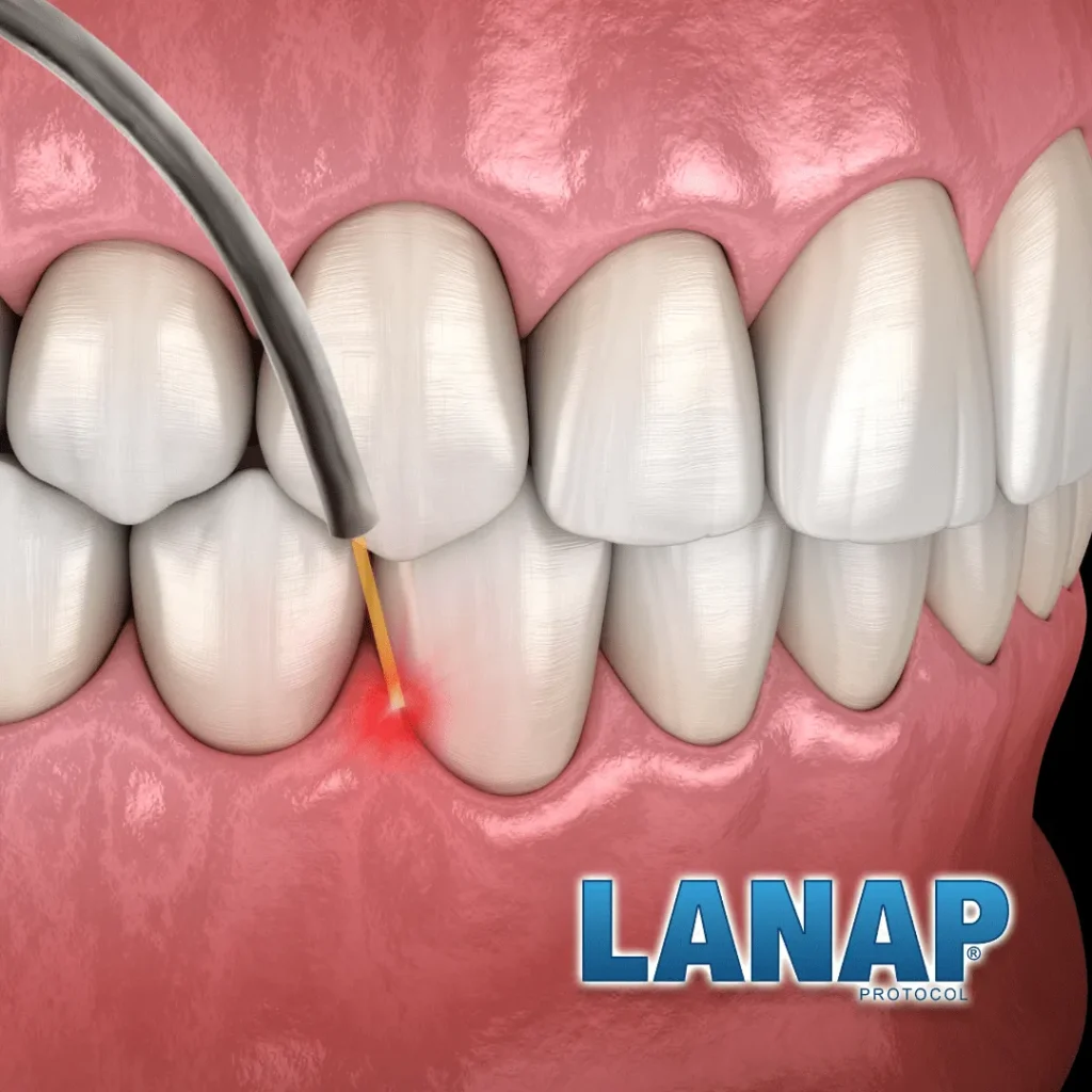 LANAP Gum Treatment